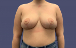 Breast Reduction 1 After